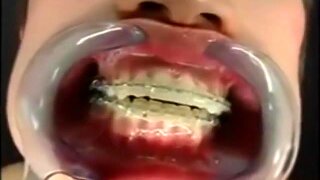 Japanese girl with braces and cheek retractors